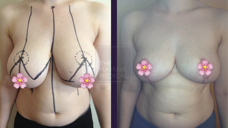 breast reduction-before and after 2
