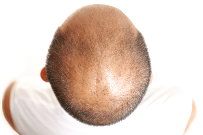 hair loss