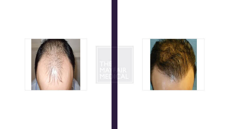 hair transplant-before and after 2