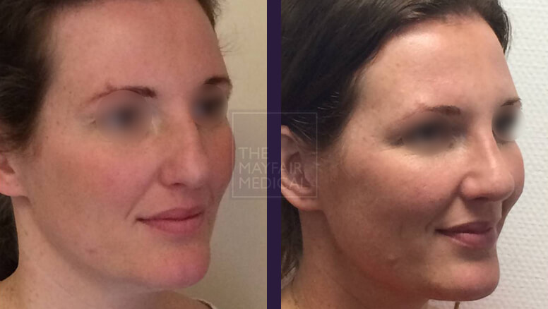 rhinoplasty-before and after 2