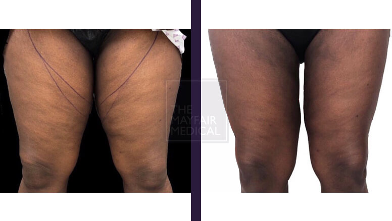 thigh lift - before and after 2