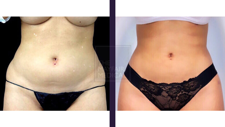 tummy tuck - before and after