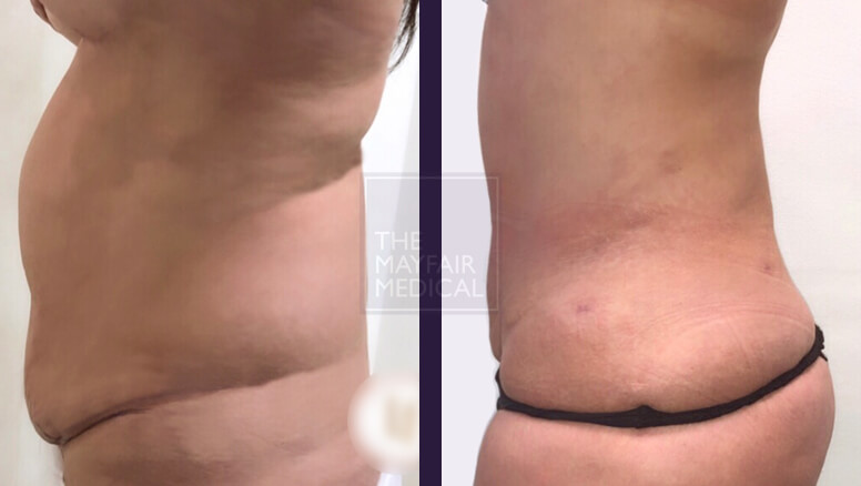 vaser liposuction-before and after 1