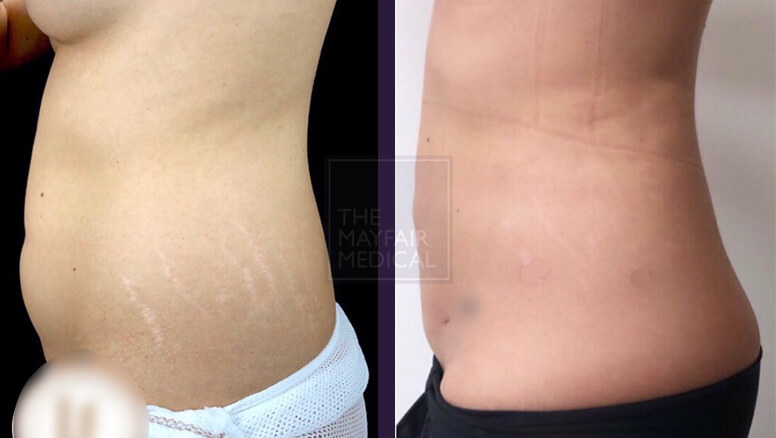 vaser liposuction-before and after 2