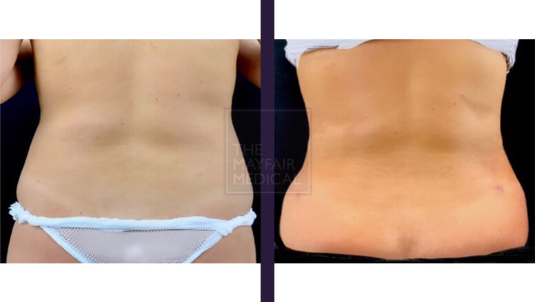 vaser liposuction-before and after 3