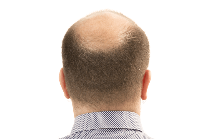 hair loss in men